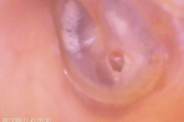 Videoohr und Nase C amera Digital-Otoscope für Perforierung der tympanischen Membran