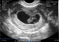 Transvaginaler Endokavitäts-tragbarer Schwangerschafts-Scanner für tragbaren OB-/GYN-Ultraschall