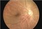 Inspektions-Ophthalmoskop H.264 Digital Fundus-Kamera