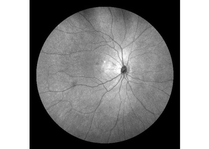 Ultra-weite Augenausrüstung Feld-Laser-Scannen-Retina Angiograph Digital mit optischem lautem Summen 100°/60°/30°