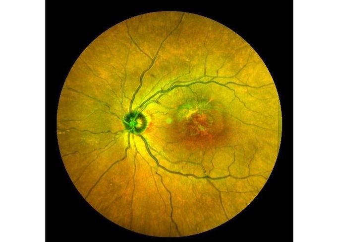 Ultra-weite Augenausrüstung Feld-Laser-Scannen-Retina Angiograph Digital mit optischem lautem Summen 100°/60°/30°