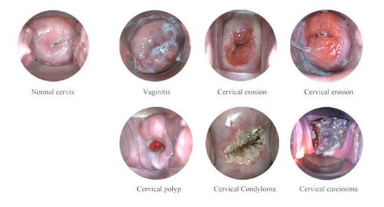 Tragbares digitales elektronisches Kolposkop
