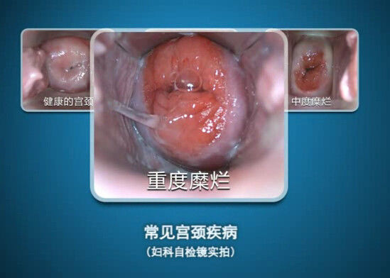 Digital-Endoscope Selbst-kontrollieren Colposcope Minicolposcopy mit Strecke Beobachtung 70~100mm