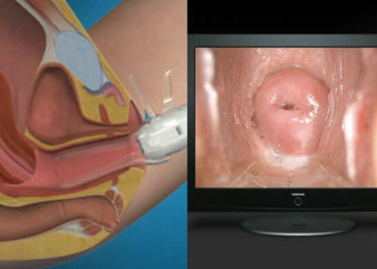 Digital-Endoscope Selbst-kontrollieren Colposcope Minicolposcopy mit Strecke Beobachtung 70~100mm