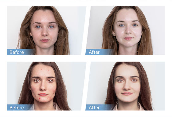 Neuester 4-Pol EMS Automatischer Serum Applikator Hydra Pen H5 Gesichtshaut Derma Mikronadelstift Essenz Kollagen Regeneration